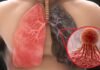 Innovación en los exámenes de detección y el tratamiento del cáncer de pulmón
